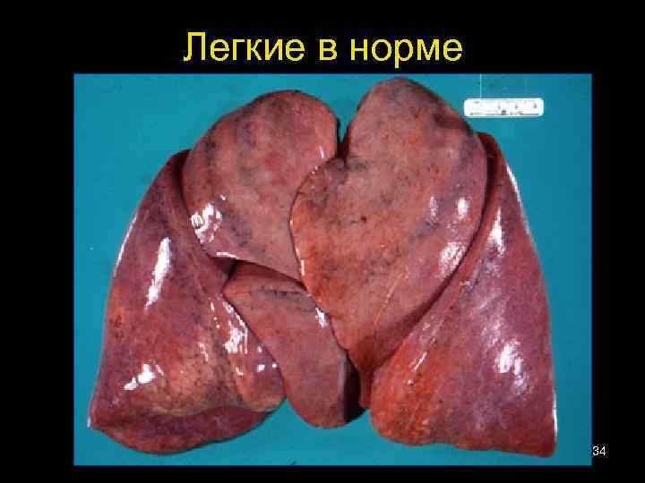 Легкие в норме 34 