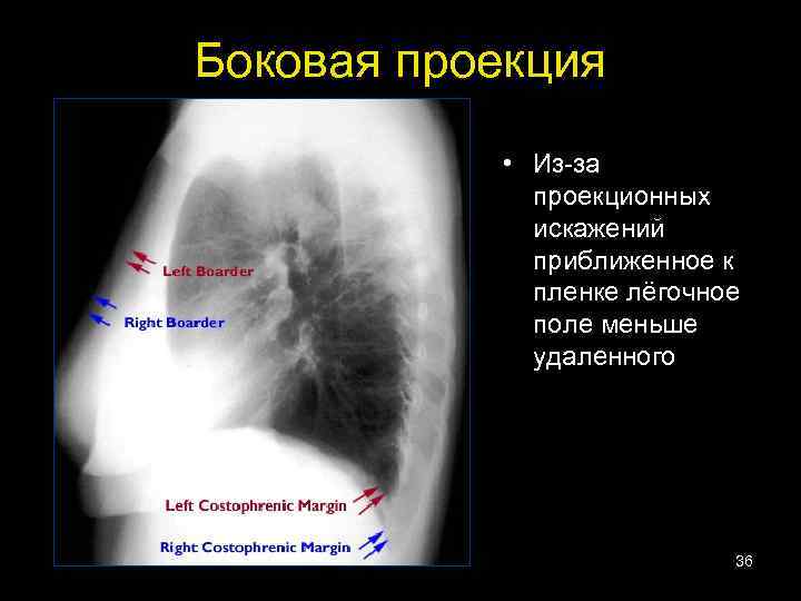 Боковая проекция • Из-за проекционных искажений приближенное к пленке лёгочное поле меньше удаленного 36