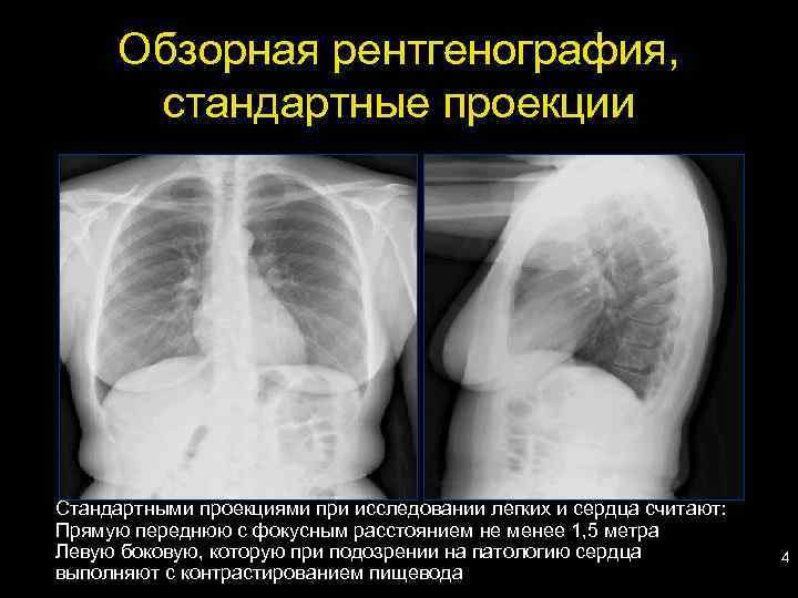 Рентген в двух проекциях. Задняя проекция грудной клетки рентген. Рентген грудной клетки сбоку. Рентген грудной клетки в боковой проекции норма. Рентген органов грудной клетки 2 проекции.