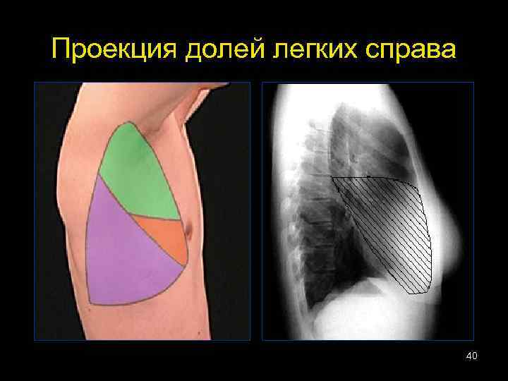 Проекция долей легких справа 40 