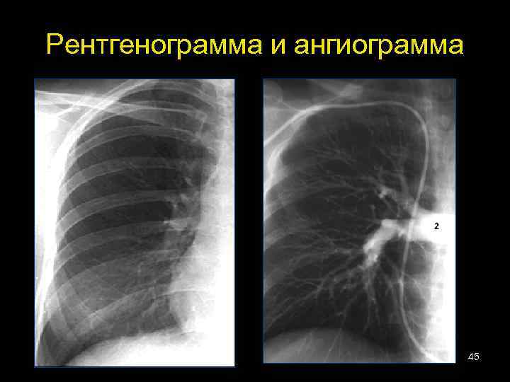 Рентгенограмма и ангиограмма 45 