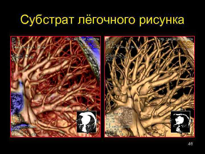 Субстрат лёгочного рисунка 46 