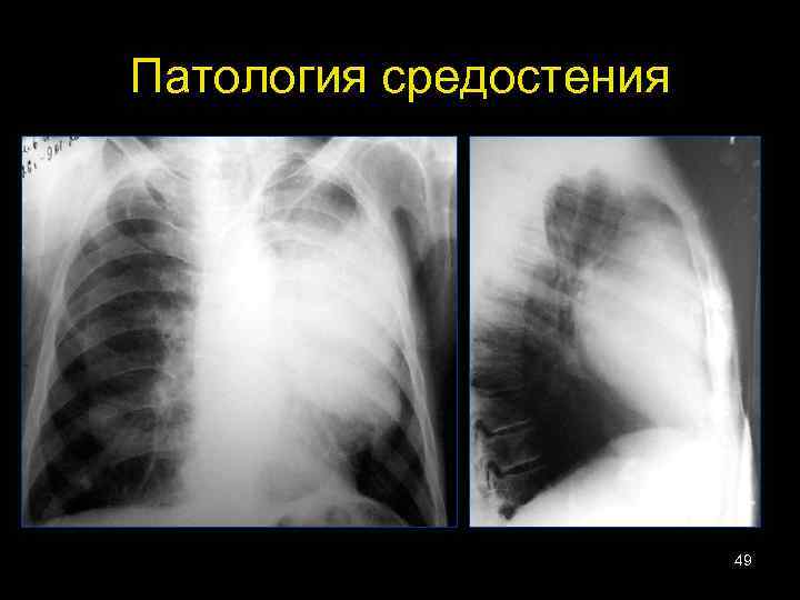Патология средостения 49 