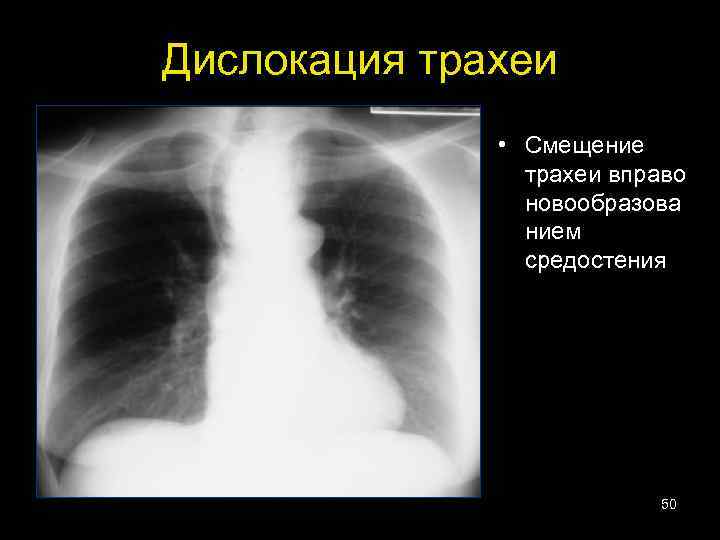 Дислокация трахеи • Смещение трахеи вправо новообразова нием средостения 50 