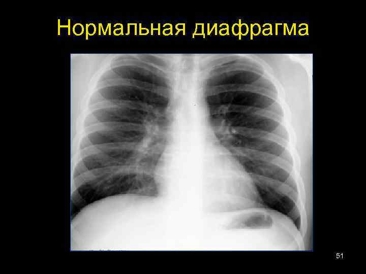 Нормальная диафрагма 51 