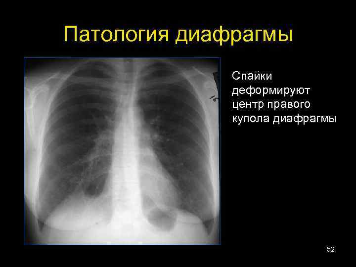 Патология диафрагмы Спайки деформируют центр правого купола диафрагмы 52 