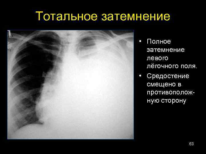 Тотальное затемнение • Полное затемнение левого лёгочного поля. • Средостение смещено в противоположную сторону