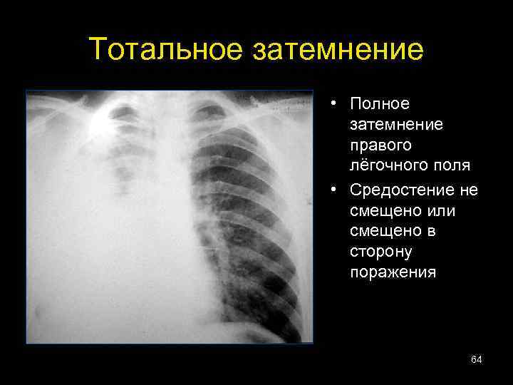 Тотальное затемнение • Полное затемнение правого лёгочного поля • Средостение не смещено или смещено