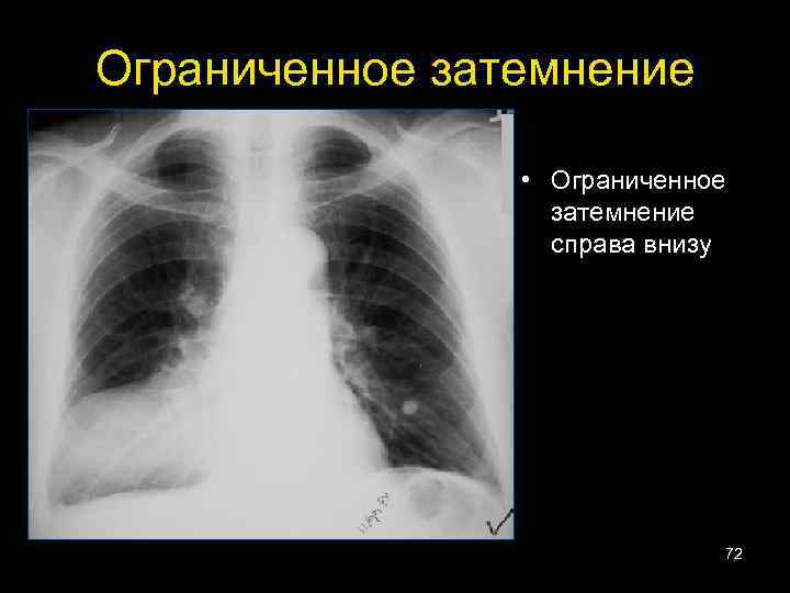 Ограниченное затемнение • Ограниченное затемнение справа внизу 72 