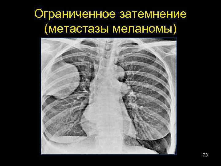 Ограниченное затемнение (метастазы меланомы) 73 