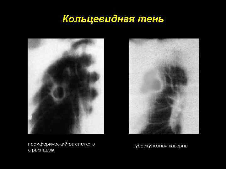 Кольцевидная тень периферический рак легкого с распадом туберкулезная каверна 