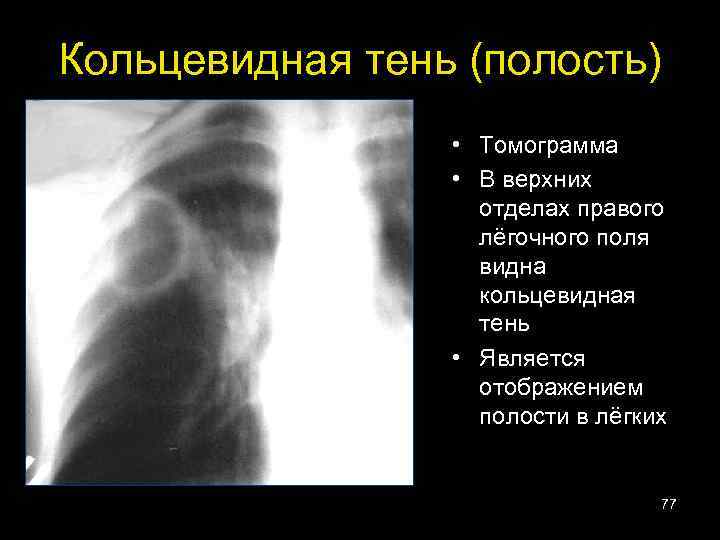 Кольцевидная тень (полость) • Томограмма • В верхних отделах правого лёгочного поля видна кольцевидная
