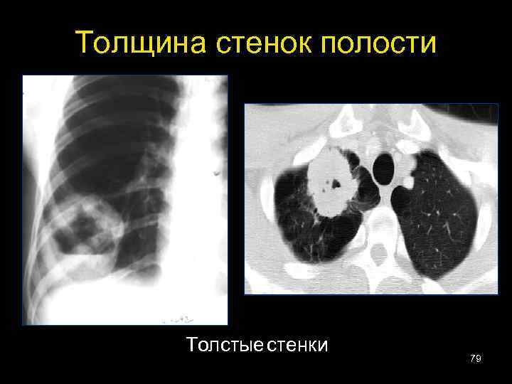 Толщина стенок полости Толстые стенки 79 