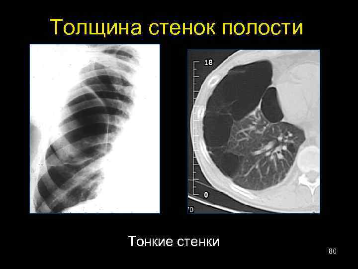 Толщина стенок полости Тонкие стенки 80 
