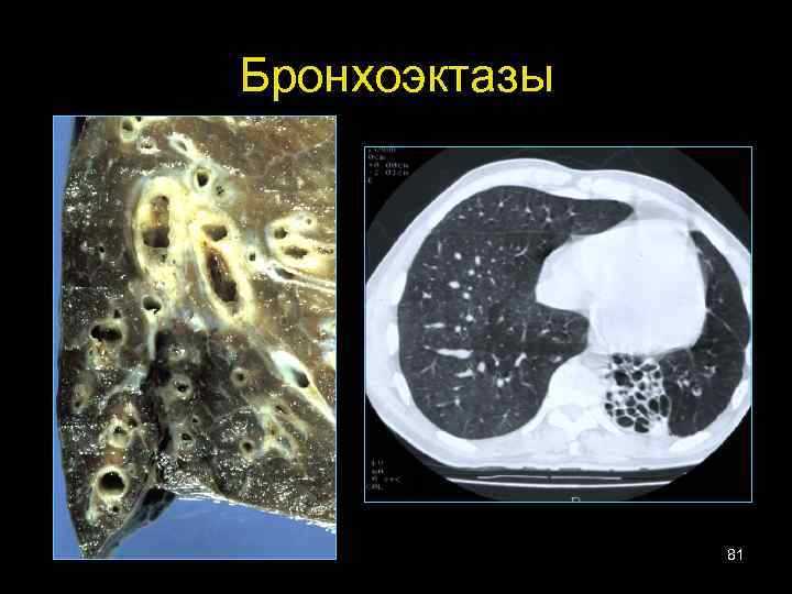 Бронхоэктазы 81 