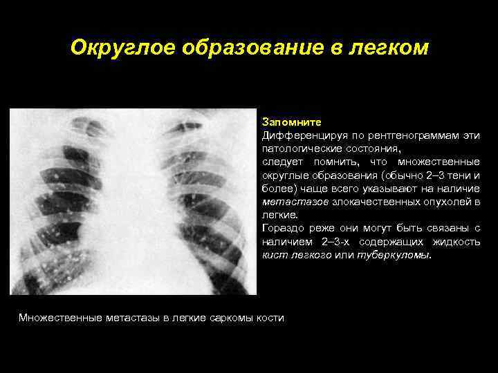 Образование в легких. Округлое образование в легком. Округлое образование в легком рентген. Множественные округлые образования в легких.