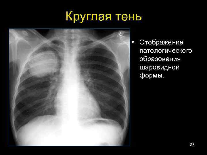 Круглая тень • Отображение патологического образования шаровидной формы. 88 