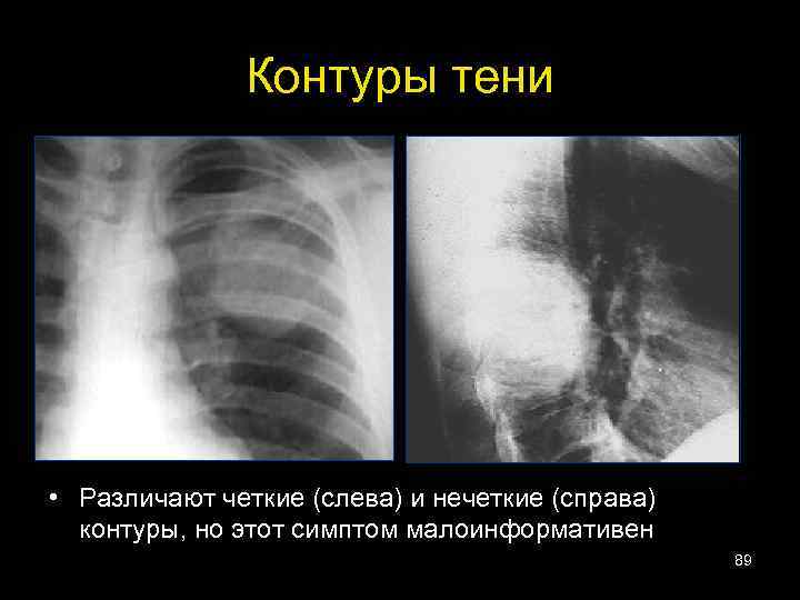 Контуры тени • Различают четкие (слева) и нечеткие (справа) контуры, но этот симптом малоинформативен