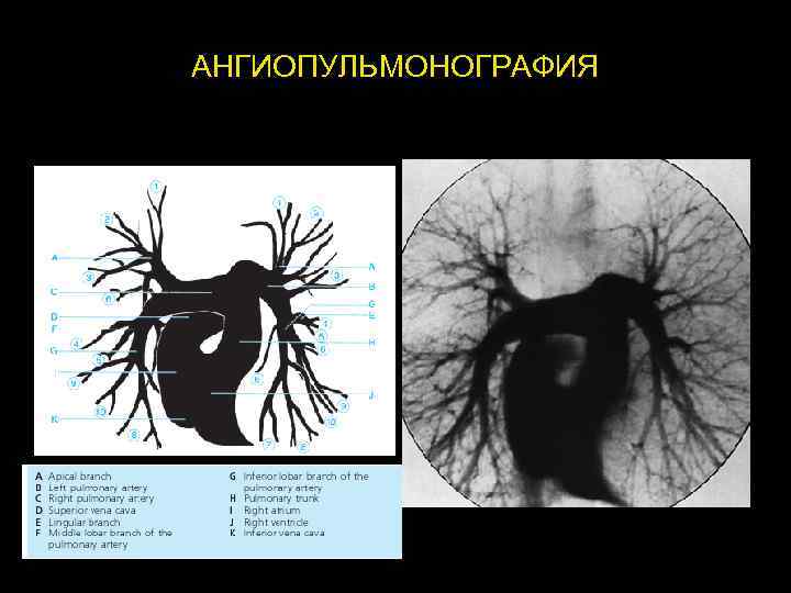 АНГИОПУЛЬМОНОГРАФИЯ 