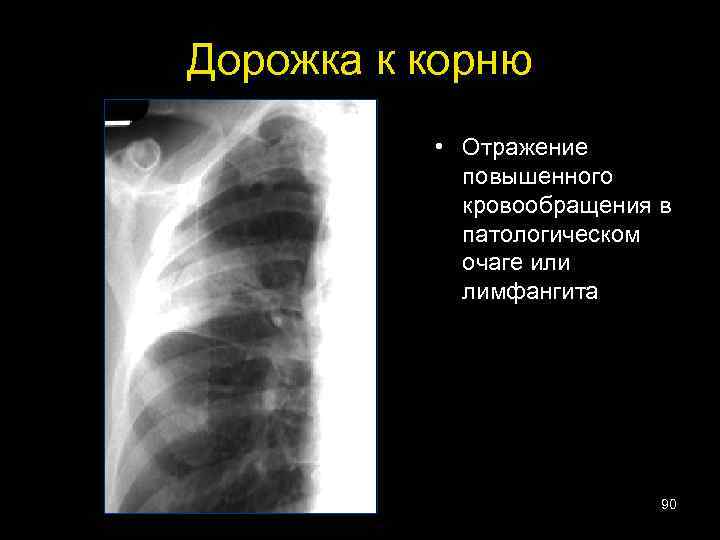 Дорожка к корню • Отражение повышенного кровообращения в патологическом очаге или лимфангита 90 