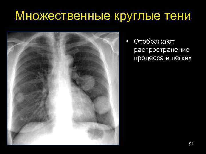 Множественные круглые тени • Отображают распространение процесса в легких 91 