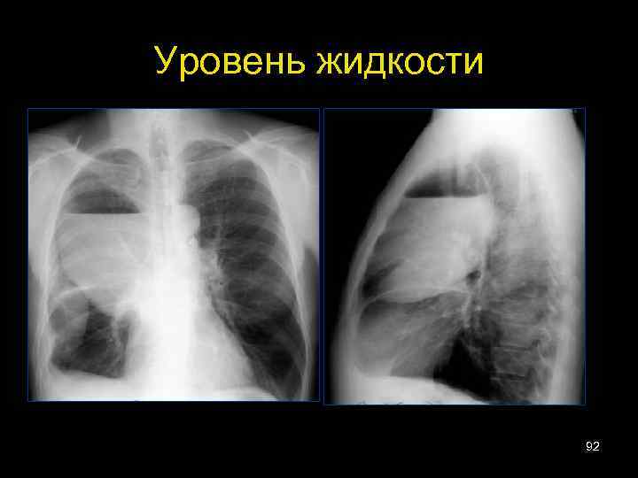 Уровень жидкости 92 