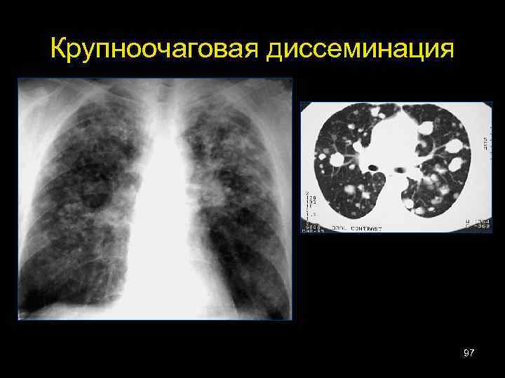 Крупноочаговая диссеминация 97 