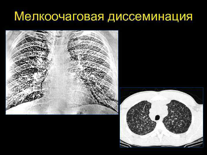 Мелкоочаговая диссеминация 98 