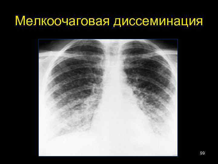 Мелкоочаговая диссеминация 99 