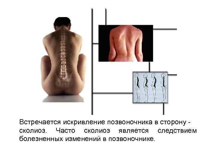 Встречается искривление позвоночника в сторону сколиоз. Часто сколиоз является следствием болезненных изменений в позвоночнике.