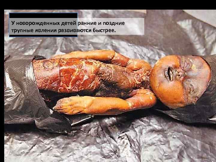 У новорожденных детей ранние и поздние трупные явления развиваются быстрее. 