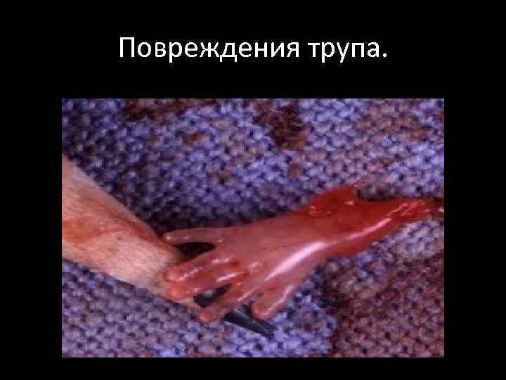 Повреждения трупа. 