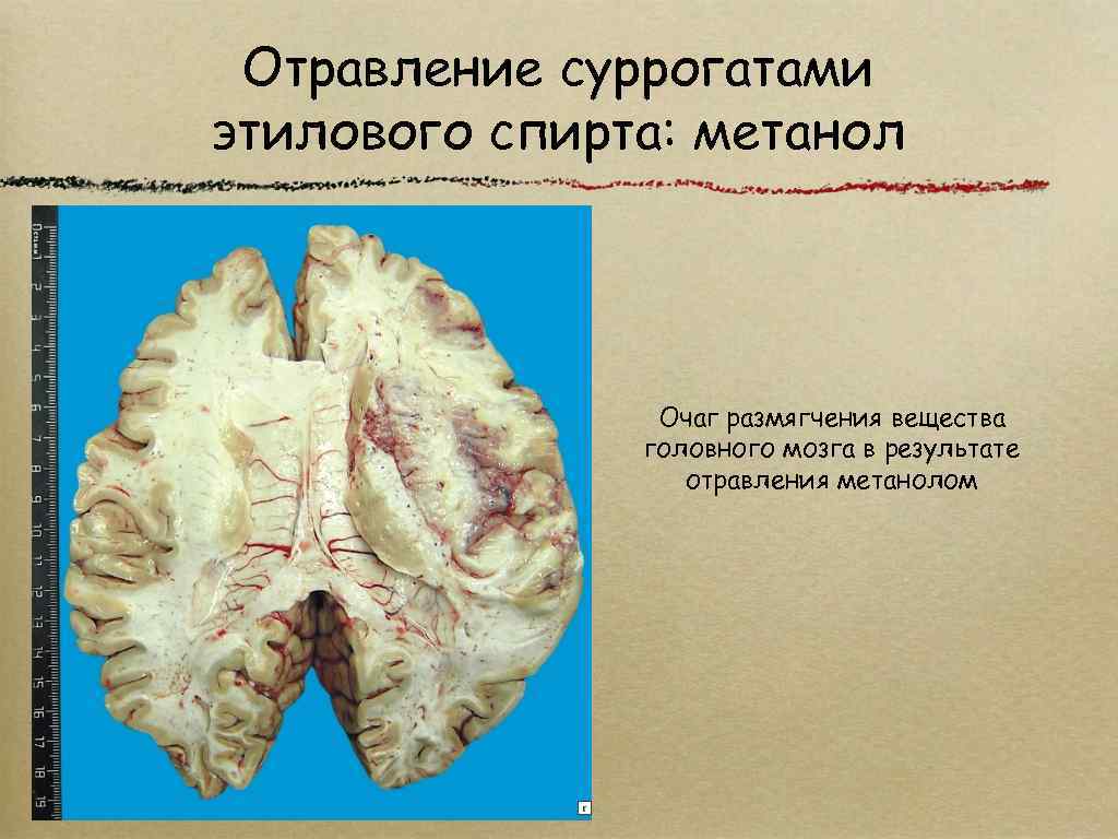 Отравление суррогатами этилового спирта: метанол Очаг размягчения вещества головного мозга в результате отравления метанолом