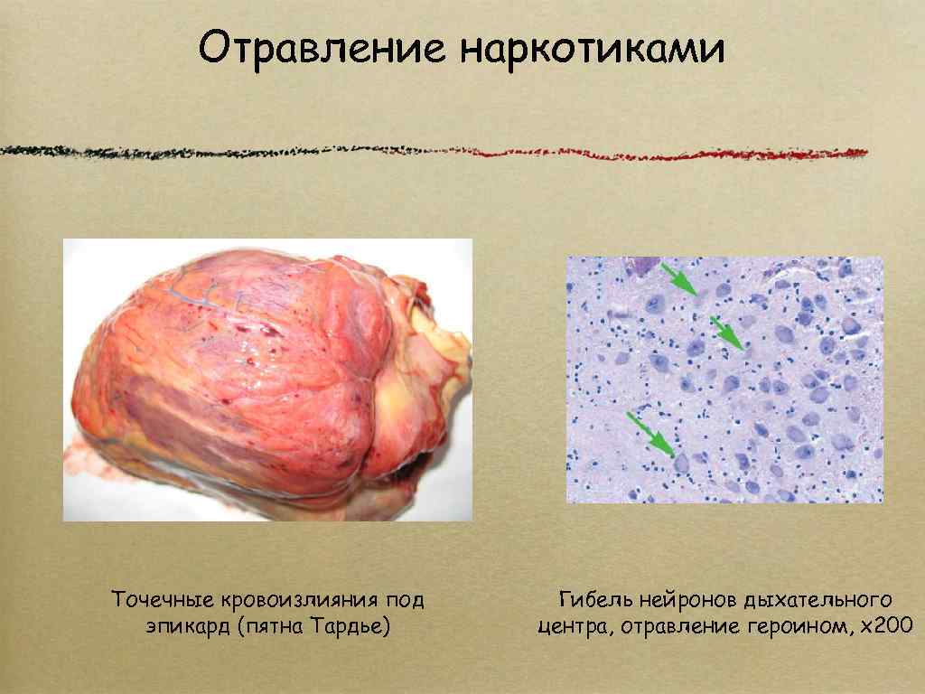 Для клинической картины инволюционного параноида характерно