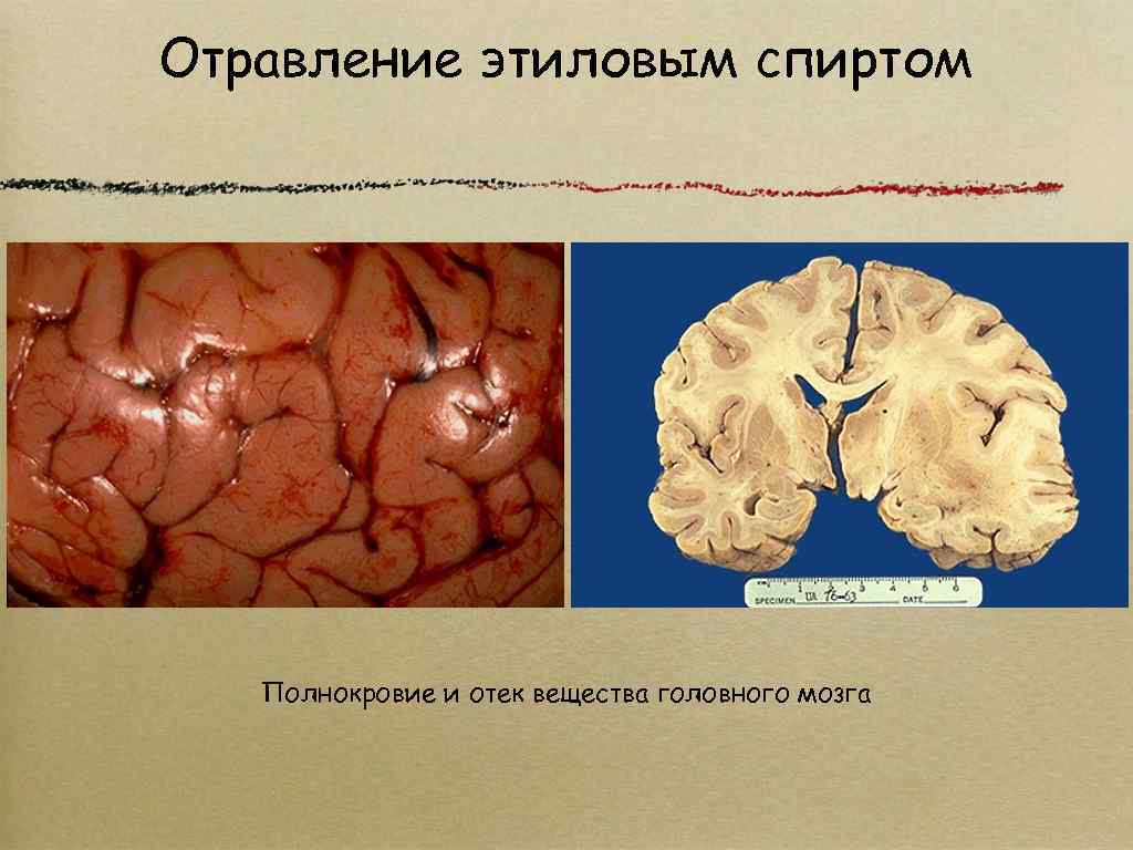 Отравление этиловым спиртом Полнокровие и отек вещества головного мозга 