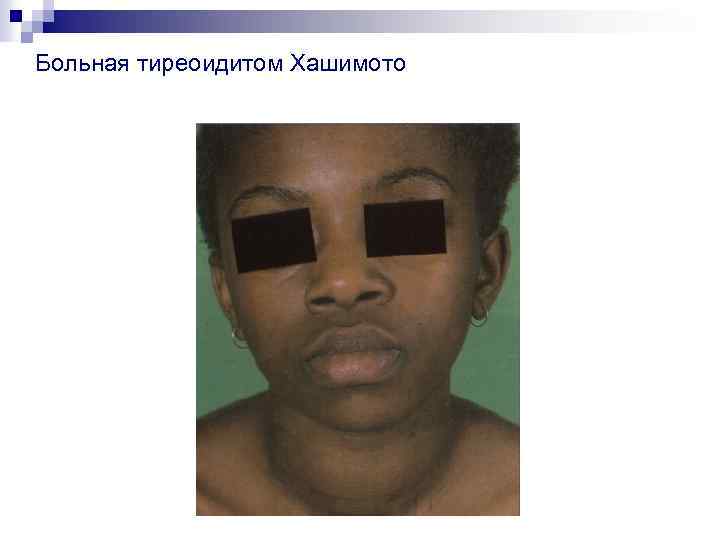 Больная тиреоидитом Хашимото 