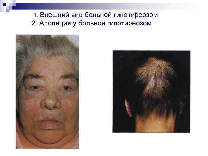 1. Внешний вид больной гипотиреозом 2. Алопеция у больной гипотиреозом 