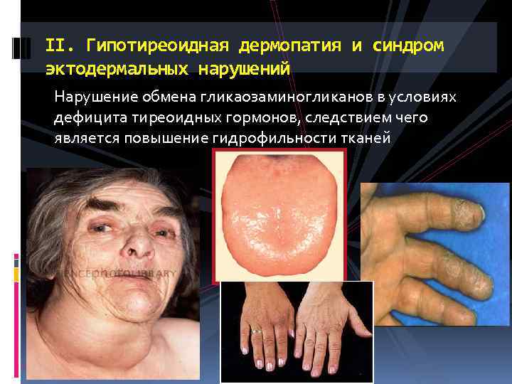 II. Гипотиреоидная дермопатия и синдром эктодермальных нарушений Нарушение обмена гликаозаминогликанов в условиях дефицита тиреоидных