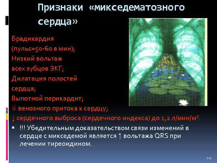 Признаки «микседематозного сердца» Брадикардия (пульс=50 60 в мин); Низкий вольтаж всех зубцов ЭКГ; Дилатация