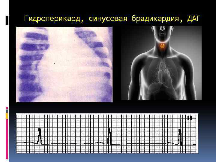 Гидроперикард, синусовая брадикардия, ДАГ 