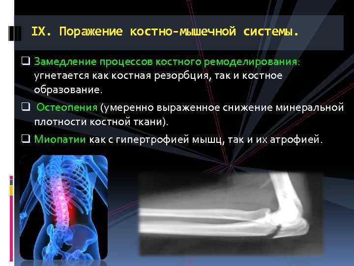 IX. Поражение костно-мышечной системы. q Замедление процессов костного ремоделирования: угнетается как костная резорбция, так