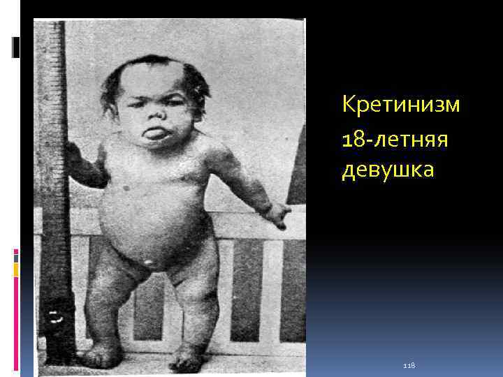 Кретинизм 18 летняя девушка 118 