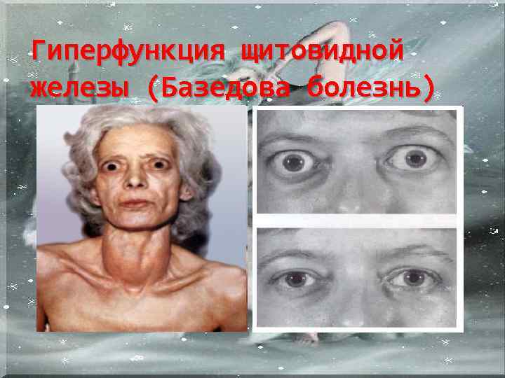 Гиперфункция щитовидной железы (Базедова болезнь) 