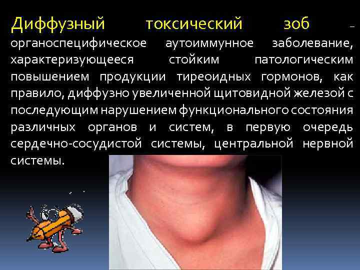 Диффузный токсический зоб – органоспецифическое аутоиммунное заболевание, характеризующееся стойким патологическим повышением продукции тиреоидных гормонов,