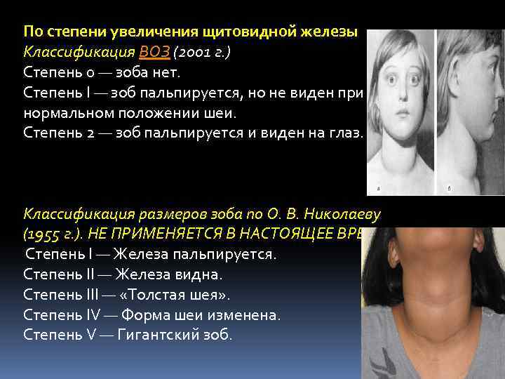 По степени увеличения щитовидной железы Классификация ВОЗ (2001 г. ) Степень 0 — зоба