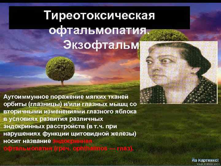 Тиреотоксическая офтальмопатия. Экзофтальм Аутоиммунное поражение мягких тканей орбиты (глазницы) и/или глазных мышц со вторичными