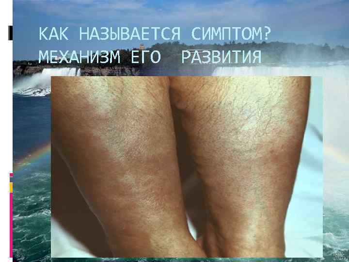 КАК НАЗЫВАЕТСЯ СИМПТОМ? МЕХАНИЗМ ЕГО РАЗВИТИЯ 