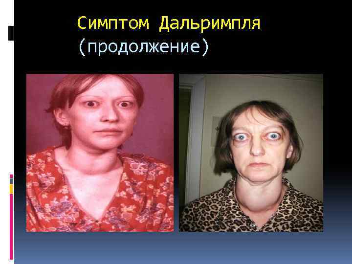 Симптом Дальримпля (продолжение) 