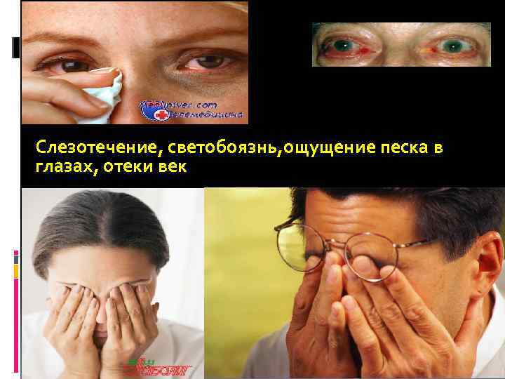 Слезотечение, светобоязнь, ощущение песка в глазах, отеки век 