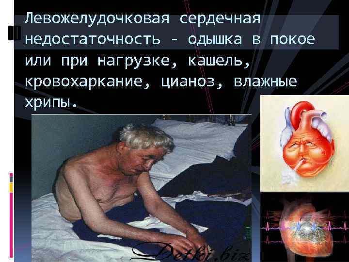 Левожелудочковая сердечная недостаточность - одышка в покое или при нагрузке, кашель, кровохаркание, цианоз, влажные